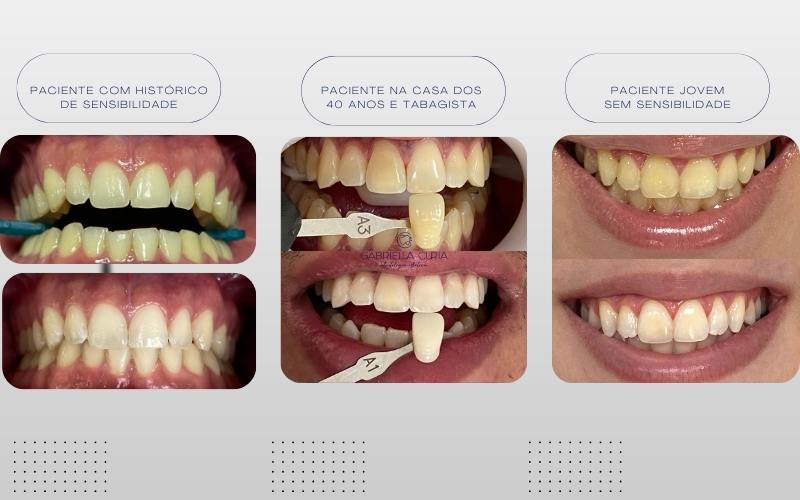 Clareamento dental - Clinica Odontologia - odontologique