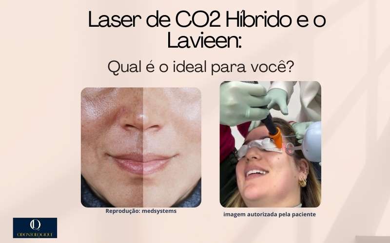Laser de CO2 Híbrido e o Lavieen