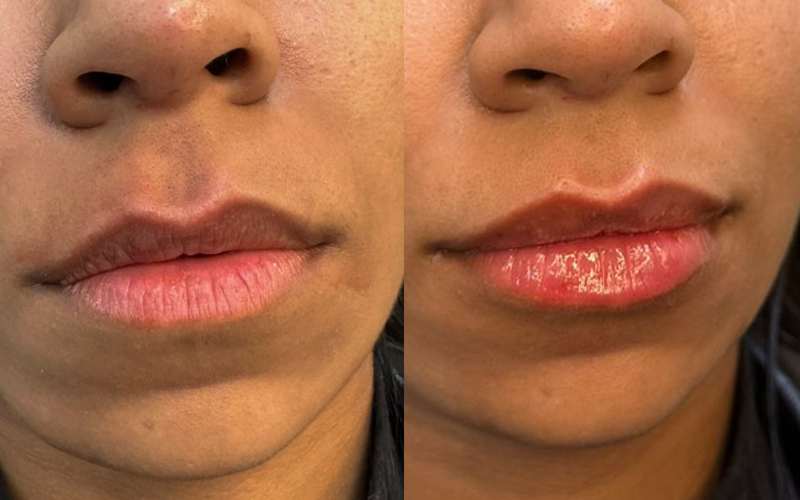 preenchimento labial